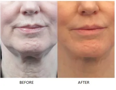 RF skin tightening