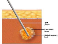 RF Chemotherapy: 5 Advantages and Disadvantages