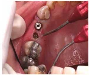 Diode laser application