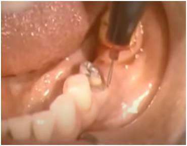 Electrosurgery in dentistry