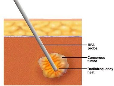 RF ablation as chemotherapy treatment