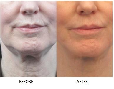 RF skin tightening