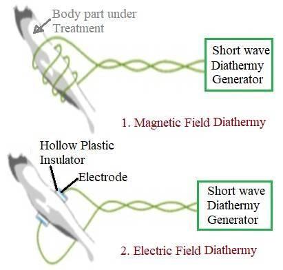 Short wave diathermy