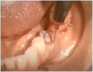Electrosurgery in dentistry