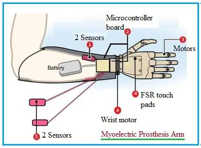 What is Myoelectric Prosthesis Arm : Working, Advantages Disadvantages