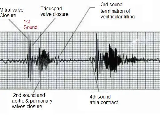 What is PCG: 5 Advantages and Disadvantages of Phonocardiography