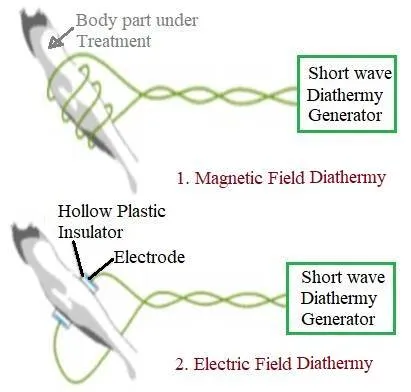 Short Wave vs. Microwave vs. Ultrasonic Diathermy: Key Differences